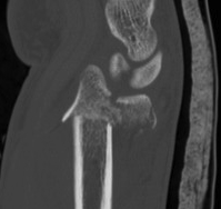 Distal Radial Fracture CT